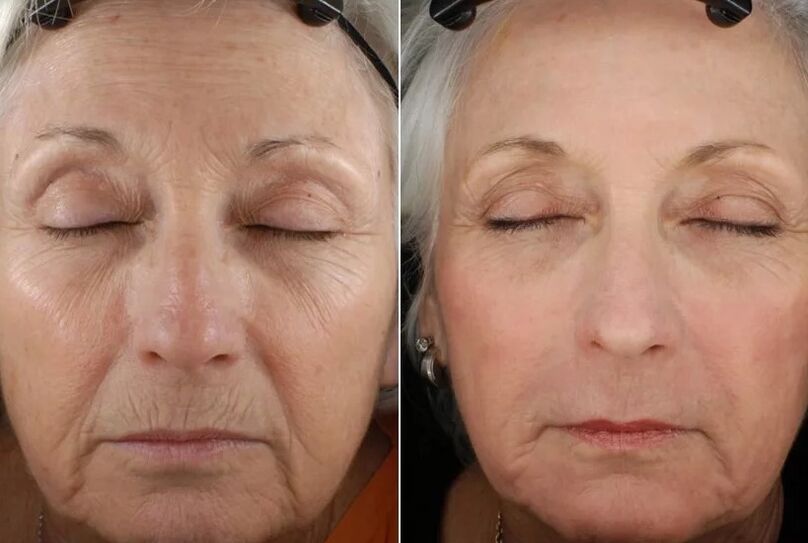 Fractional rejuvenation results