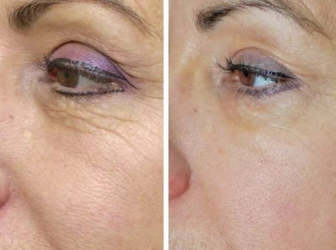 Laser field before and after