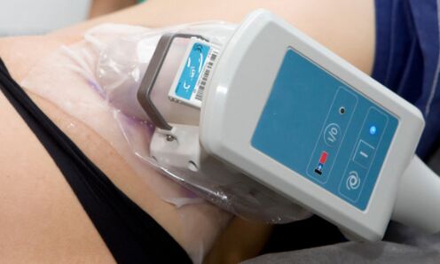 cryolipolysis for body skin